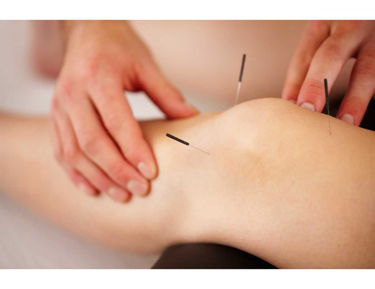 How Acupuncture Works Electrical Stimulation "EStim" Acupuncture