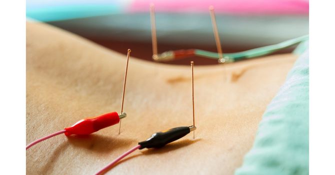 Electrical Stimulation "E-Stim" Acupuncture